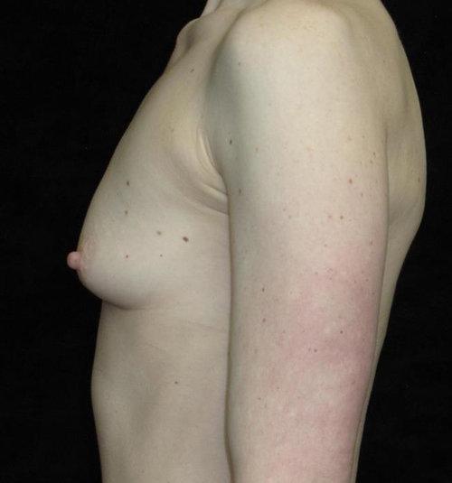 Breast Augmentation Patient Photo - Case 133 - before view-1