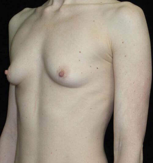 Breast Augmentation Patient Photo - Case 133 - before view-