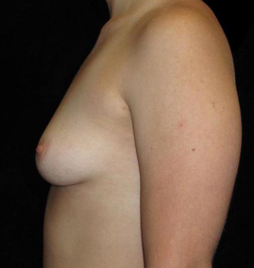 Breast Augmentation Patient Photo - Case 142 - before view-1