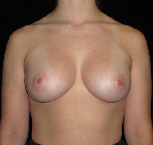 Breast Augmentation Patient Photo - Case 142 - after view