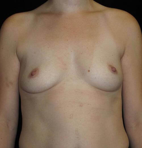 Breast Augmentation Patient Photo - Case 125 - before view-0
