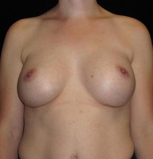 Breast Augmentation Patient Photo - Case 125 - after view-0