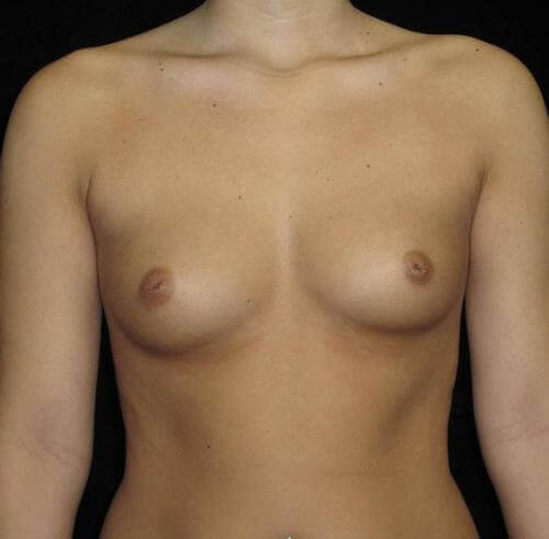 Breast Asymmetry Patient Photo - Case 129 - before view-