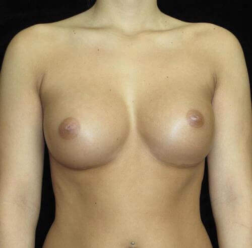 Breast Asymmetry Patient Photo - Case 129 - after view