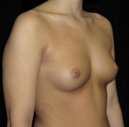 Breast Asymmetry Patient Photo - Case 129 - before view-1