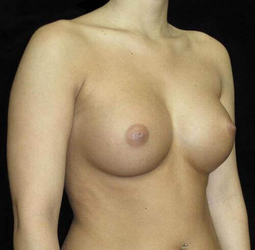Breast Asymmetry Patient Photo - Case 129 - after view-1