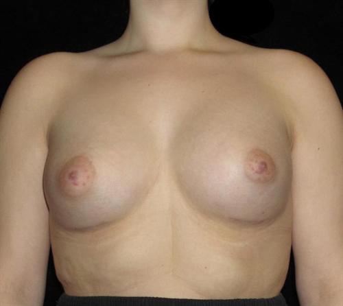 Breast Asymmetry Patient Photo - Case 147 - after view