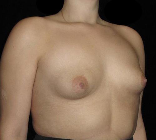 Breast Asymmetry Patient Photo - Case 147 - before view-1