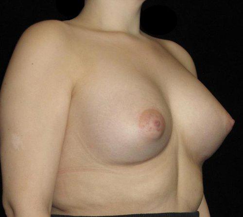 Breast Asymmetry Patient Photo - Case 147 - after view-1
