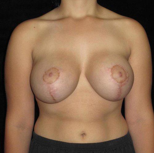 Breast Asymmetry Patient Photo - Case 150 - after view