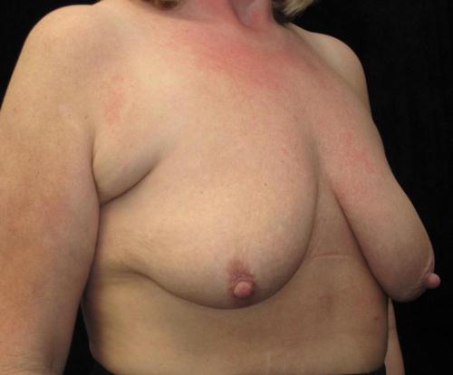 Breast Asymmetry Patient Photo - Case 110 - before view-1