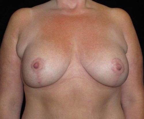 Breast Asymmetry Patient Photo - Case 110 - after view-0