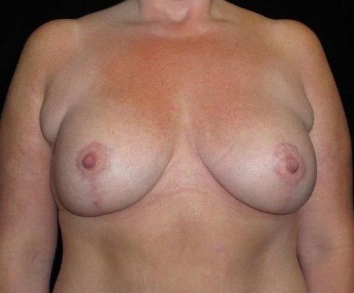 Breast Asymmetry Patient Photo - Case 110 - after view