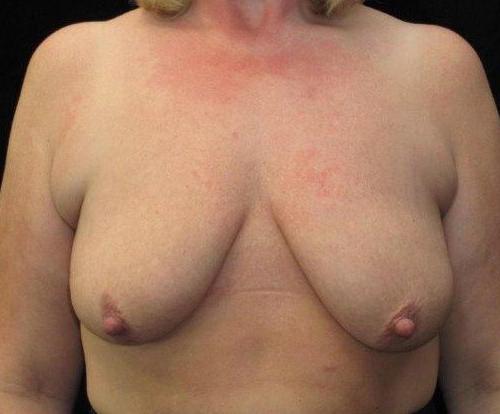 Breast Asymmetry Patient Photo - Case 110 - before view-0