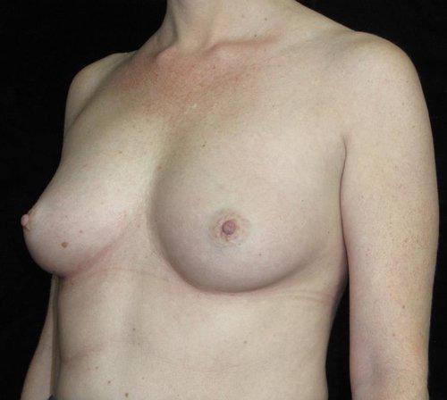 Breast Asymmetry Patient Photo - Case 144 - before view-1