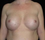 Breast Asymmetry - Case 144 - After