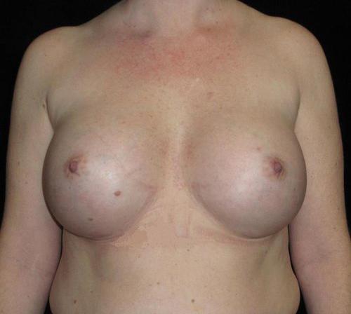 Breast Asymmetry Patient Photo - Case 144 - after view-0