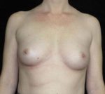 Breast Asymmetry - Case 144 - Before