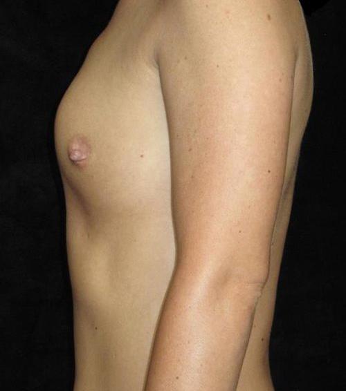 Breast Asymmetry Patient Photo - Case 151 - before view-1