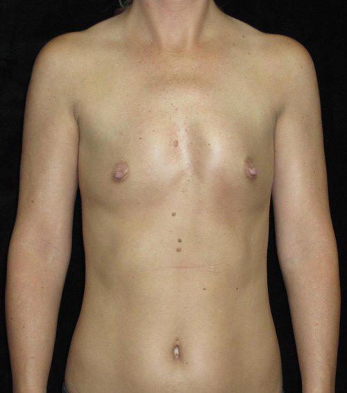 Breast Asymmetry Patient Photo - Case 151 - before view-