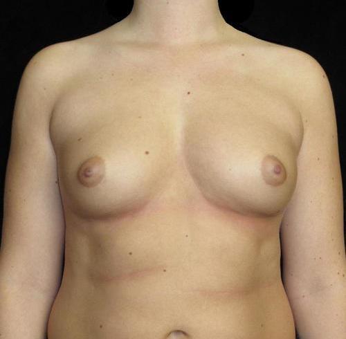 Breast Asymmetry Patient Photo - Case 123 - before view-