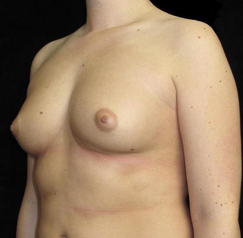 Breast Asymmetry Patient Photo - Case 123 - before view-1
