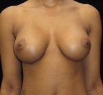 Breast Augmentation - Case 103 - After