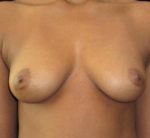 Breast Augmentation - Case 103 - Before