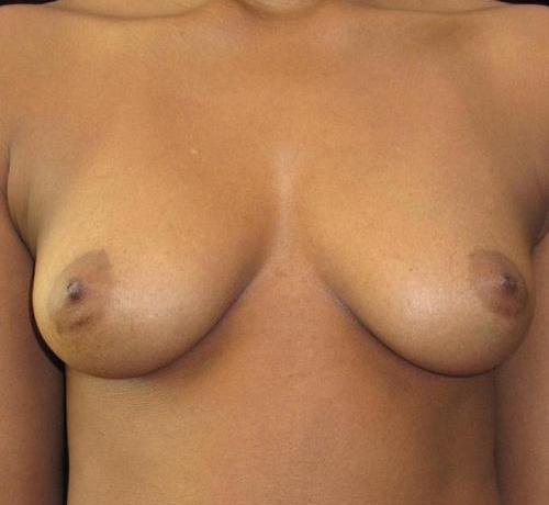 Breast Augmentation Patient Photo - Case 103 - before view-