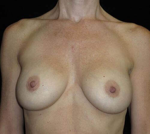 Breast Augmentation Patient Photo - Case 95 - after view