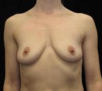 Breast Augmentation - Case 95 - Before