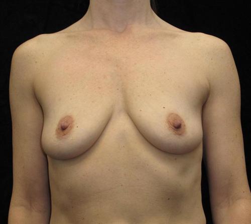 Breast Augmentation Patient Photo - Case 95 - before view-0