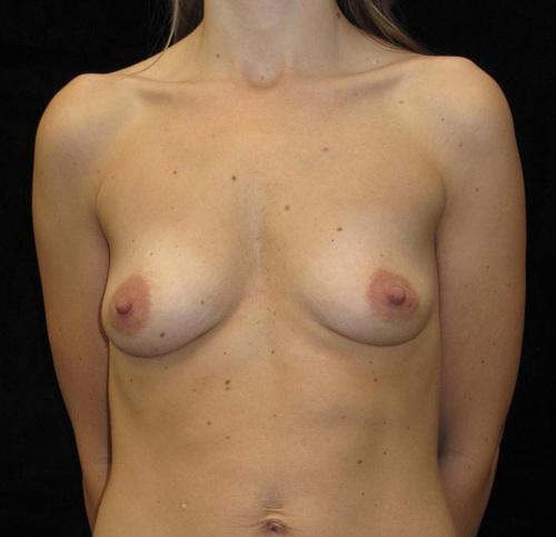 Breast Augmentation Patient Photo - Case 101 - before view-