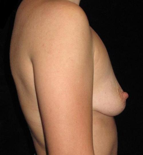 Breast Augmentation Patient Photo - Case 146 - before view-1