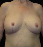 Breast lift with Augmentation - Case 97 - After