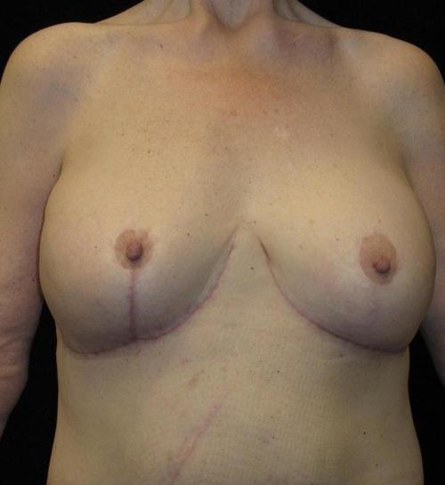Breast lift with Augmentation Patient Photo - Case 97 - after view