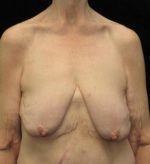 Breast lift with Augmentation - Case 97 - Before