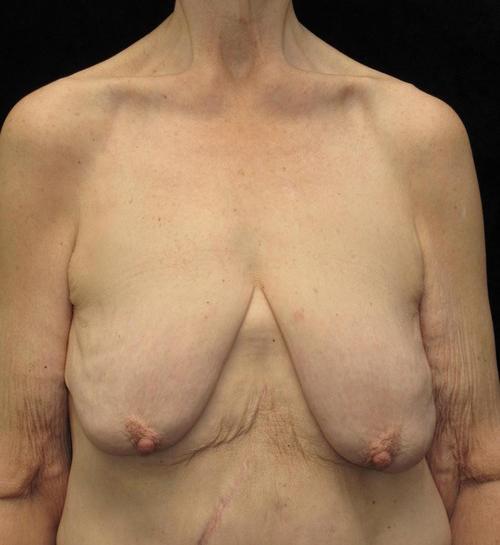 Breast lift with Augmentation Patient Photo - Case 97 - before view-0