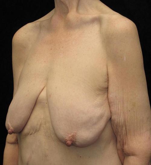Breast lift with Augmentation Patient Photo - Case 97 - before view-1