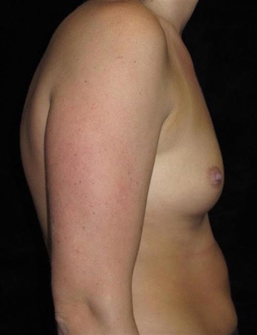 Breast Augmentation Patient Photo - Case 233 - before view-1