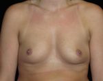 Breast Augmentation - Case 233 - Before