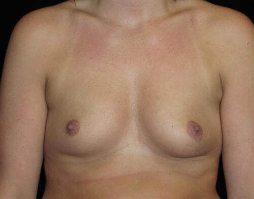 Breast Augmentation Patient Photo - Case 233 - before view-