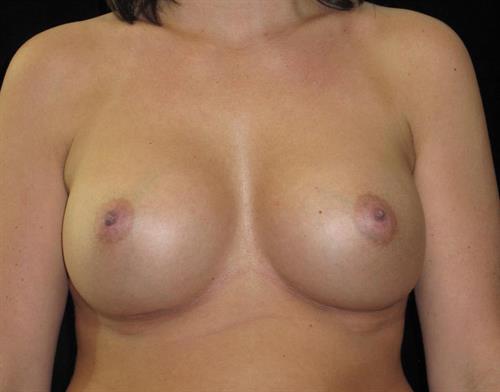 Breast Augmentation Patient Photo - Case 233 - after view