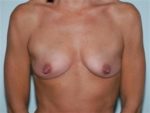Breast Augmentation - Case 160 - Before