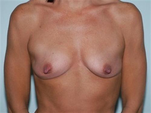 Breast Augmentation Patient Photo - Case 160 - before view-