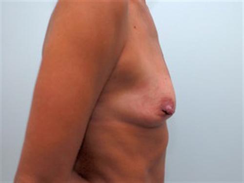 Breast Augmentation Patient Photo - Case 160 - before view-1