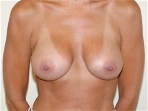 Breast Augmentation Patient Photo - Case 160 - after view-0