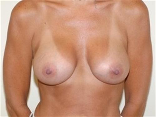 Breast Augmentation Patient Photo - Case 160 - after view