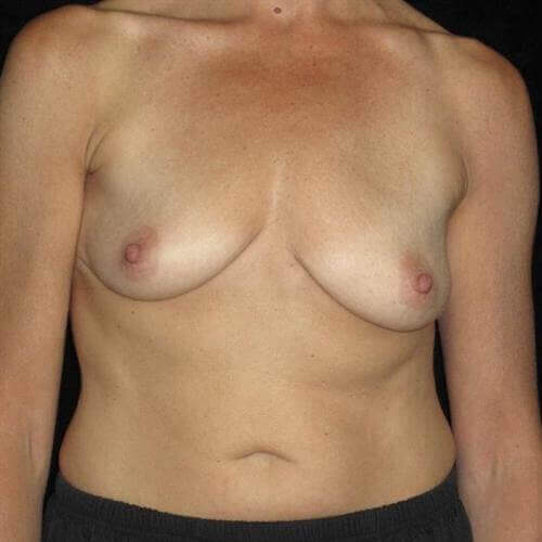 Breast Asymmetry Patient Photo - Case 201 - before view-