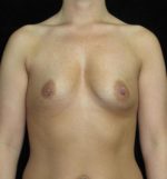 Breast Augmentation - Case 137 - Before